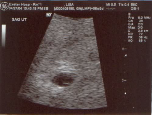 miscarriage at 7 weeks. ultrasound at 7 weeks.