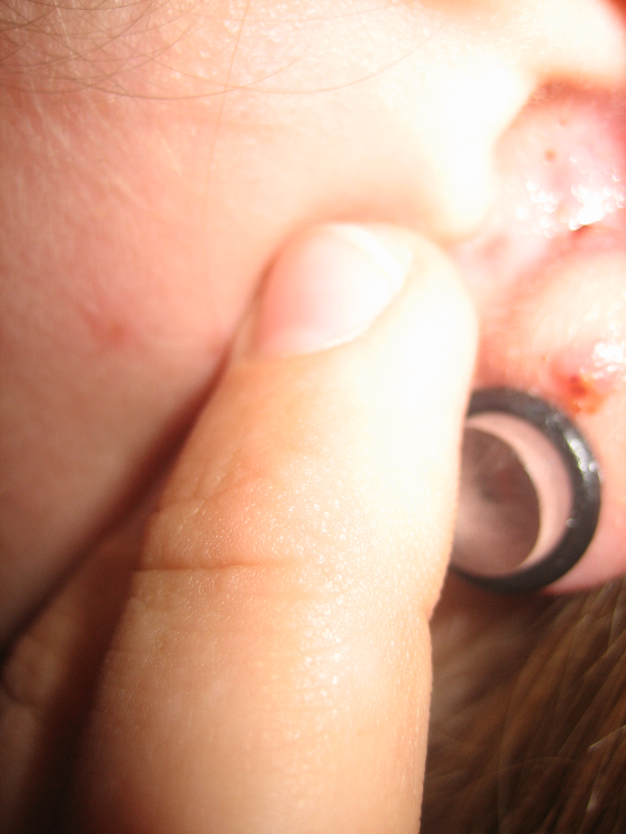 I have some pretty disgusting ones from my infected anti-tragus.