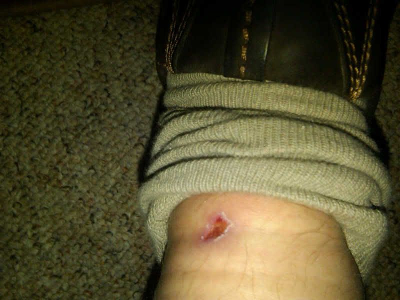 lacebite.jpg