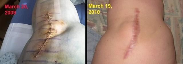 gallbladder removal scar. year old gall bladder scar