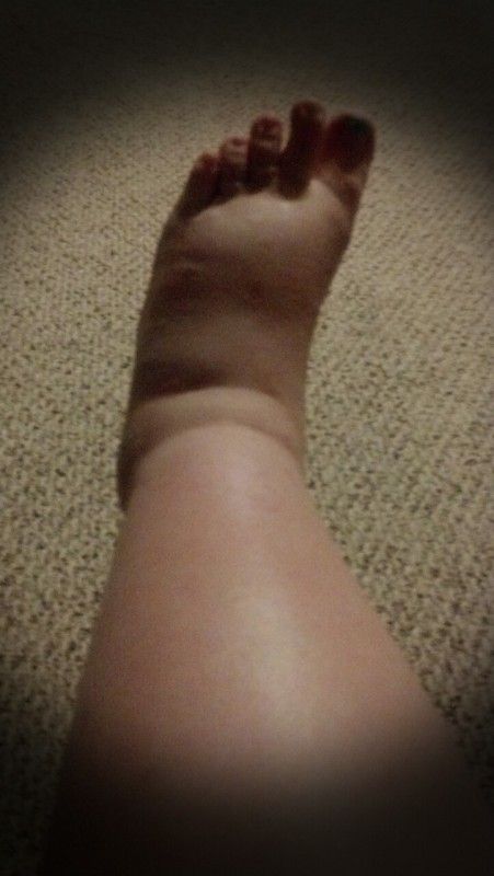 What Is Pitting Edema BabyCenter what-is-pitting-edema-babycenter