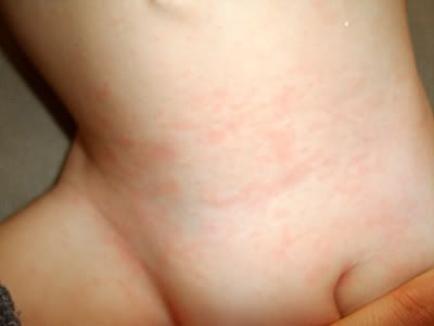 Measle Rash Pictures